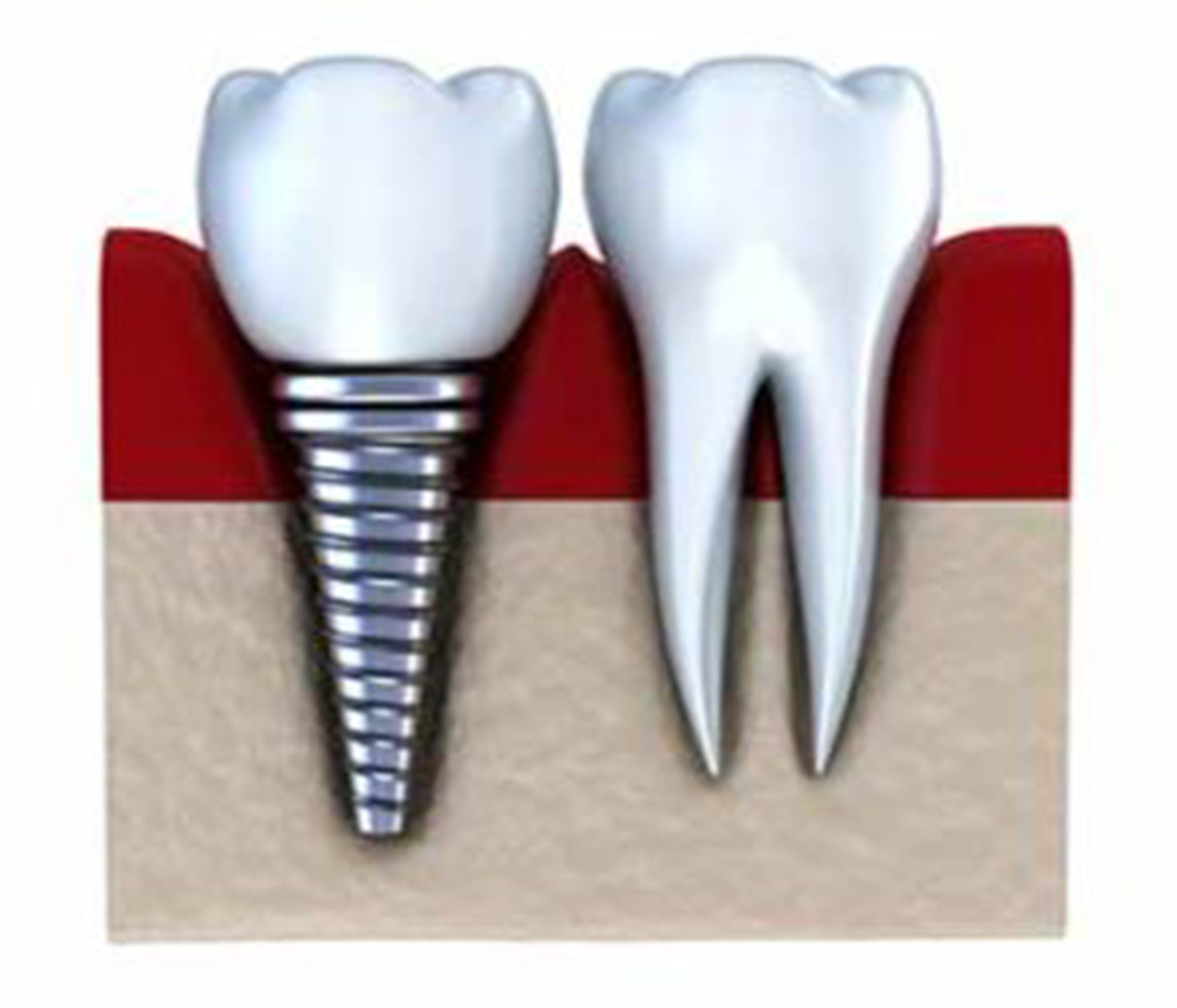 Patients of our Maine Dental Center consider the benefits of zirconia dental implants