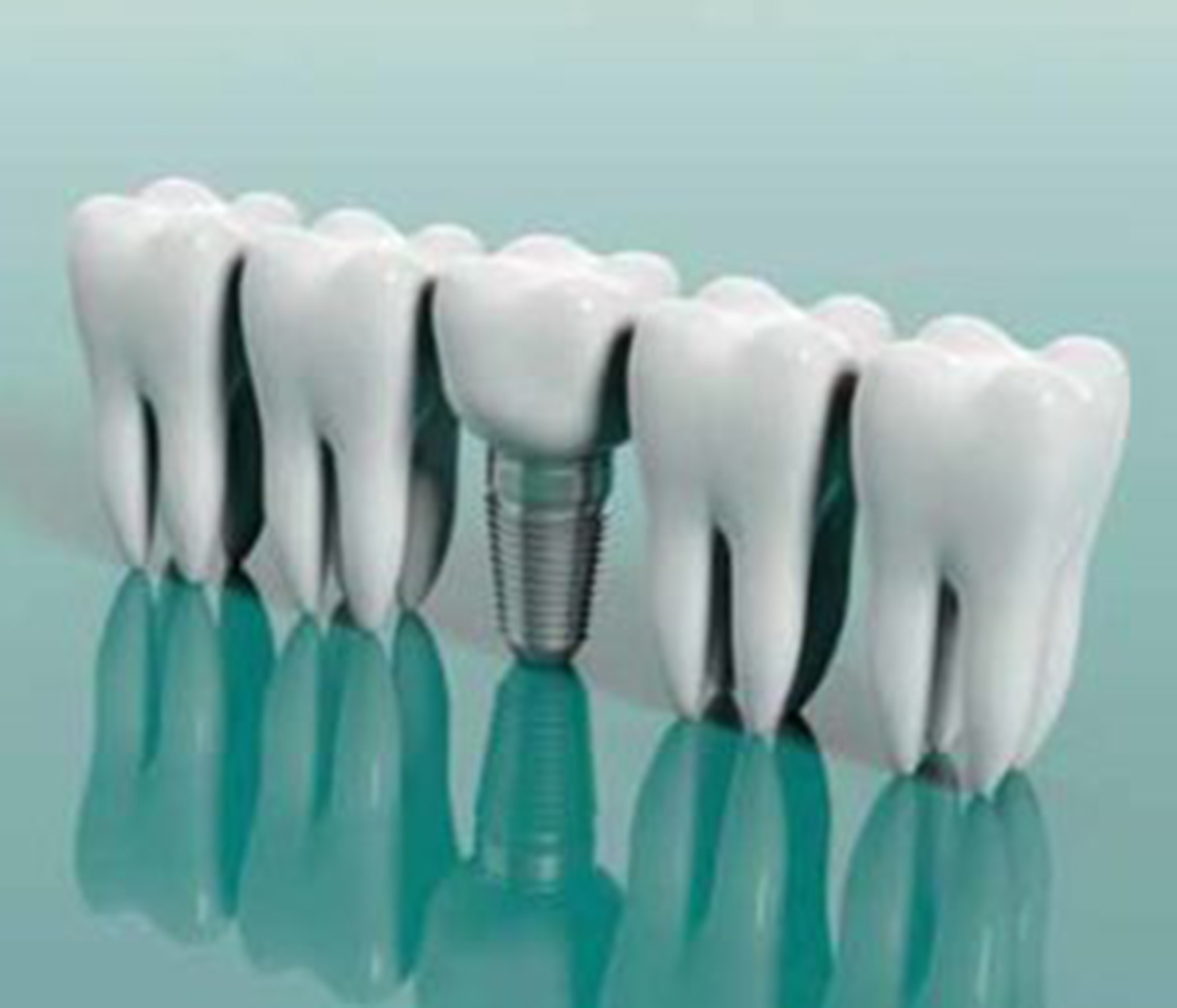 Implants from professionals at dental clinic in Skowhegan, ME permanently restore lost teeth