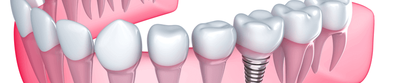 Dental Implants Skowhegan ME - Dental implants